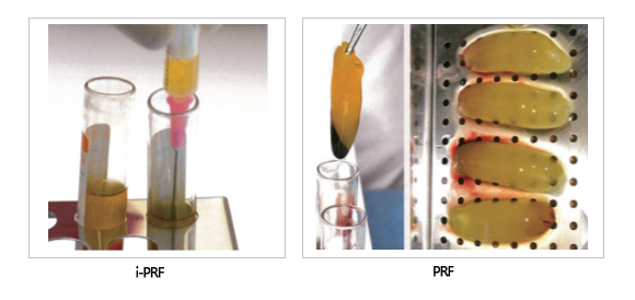 i-PRF-PRF-compare